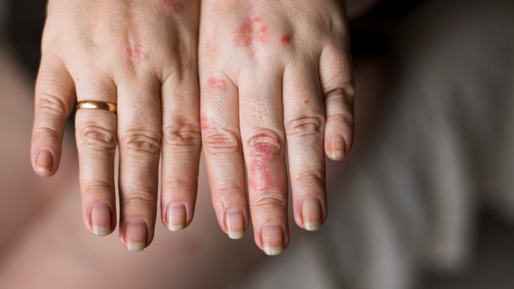 Mains gercées par les gels hydroalcooliques non conformes