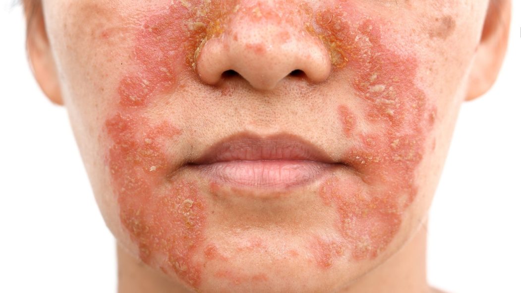 Femme moyennement atteinte par le psoriasis autour de la bouche