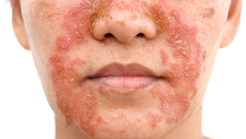 Femme moyennement atteinte par le psoriasis autour de la bouche